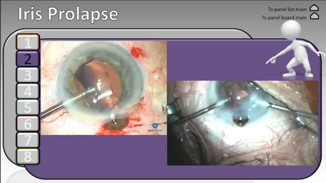 Cataract
